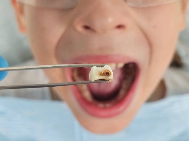 Best Emergency Treatment for Toothache in Maple Lake, MN